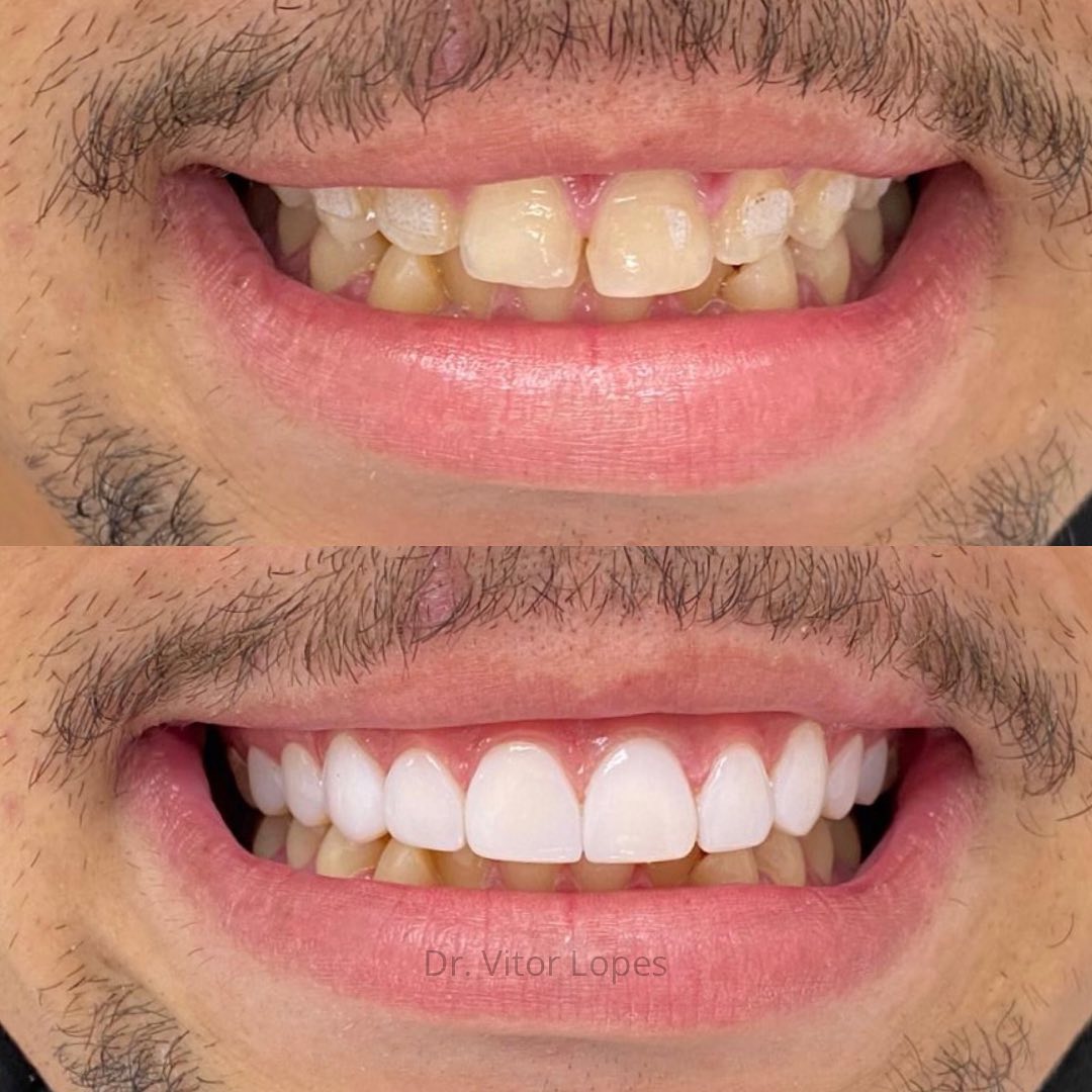 Lentes de Resina — antes e depois